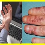 Lesiones y Enfermedades de los Dedos de la Mano