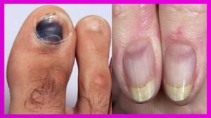 Patologías de las uñas: Causas, Síntomas y Tratamientos Las uñas como cualquier otra parte del cuerpo necesita de nuestra atención ya que su apariencia 