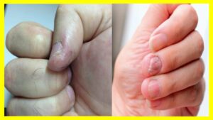 Tratamiento para la aparición de hongos en nuestras manos Es muy importante el cuidado de nuestras manos ya que con ella hacemos todo tipo de actividades.