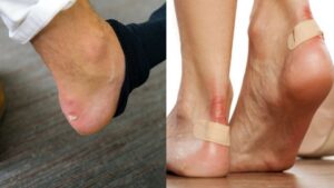 Ampollas y rozaduras en los pies: ¿Cómo curarlas y prevenirlas? Los pies están propenso a sufrir una serie de lesiones producto de la actividad diaria a los